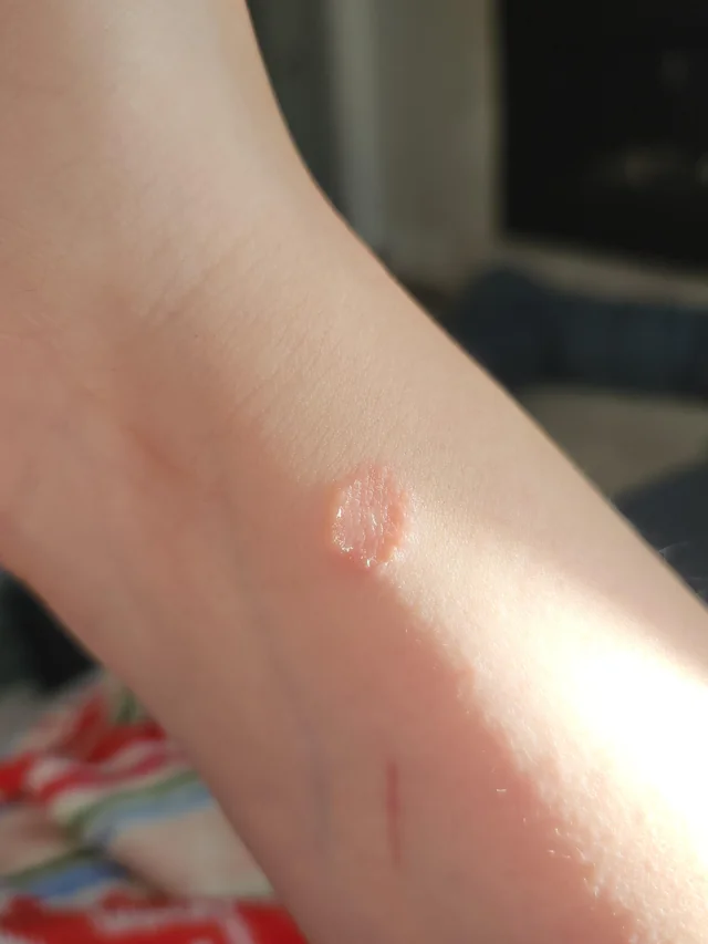 How to Prevent Ringworm and Staph in BJJ (Mat Hygiene Guide)