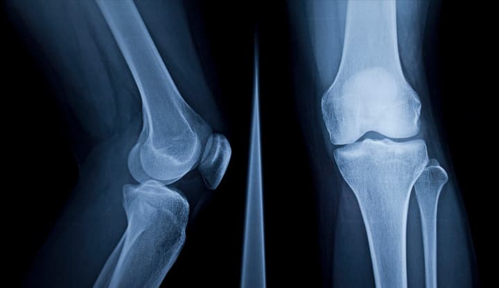 Knees, back, and neck: the three injuries that end BJJ careers